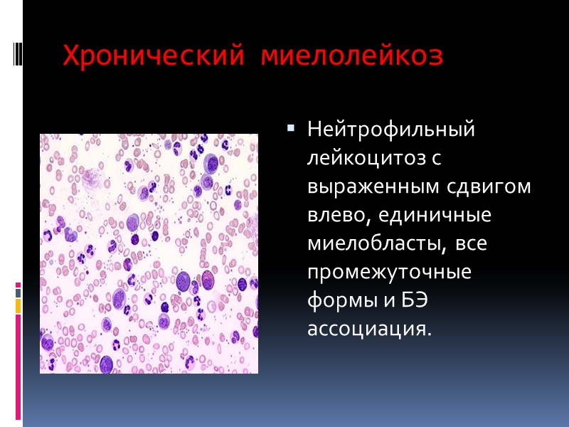 Хронический миелолейкоз Нейтрофильный лейкоцитоз с выраженным сдвигом влево, единичные миелобласты, все промежуточные формы и